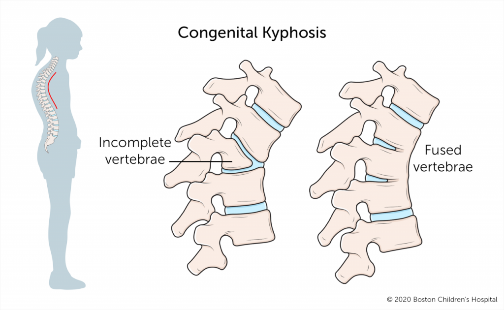 Understanding Kyphosis Causes Diagnosis And Treatment Options Becker Spine