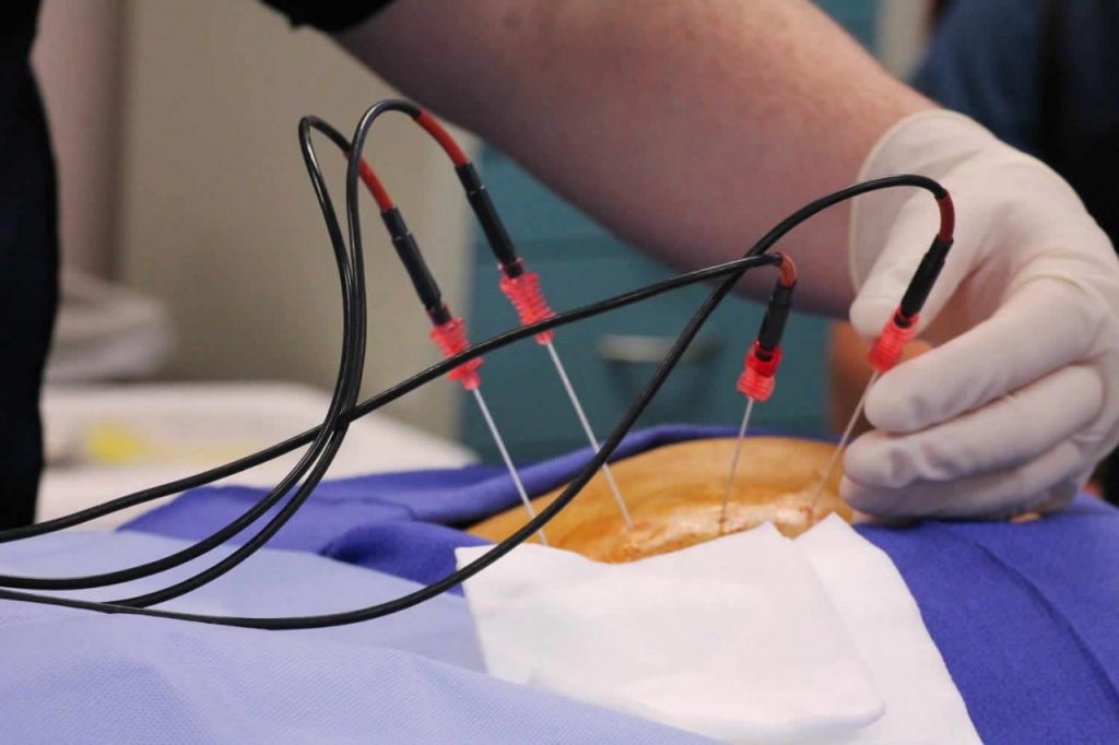 Radiofrequency Ablation Technique