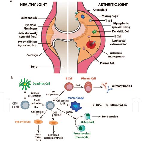 Autoimmune Arthritis Illustration
