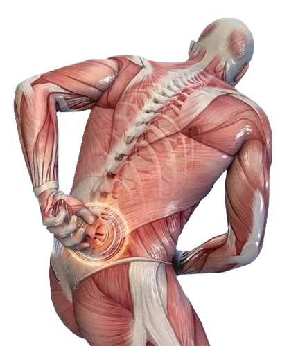 Illustration of muscle strain
