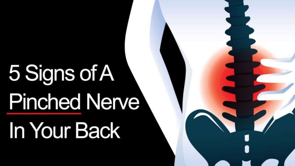 Pinched Nerve in the Back