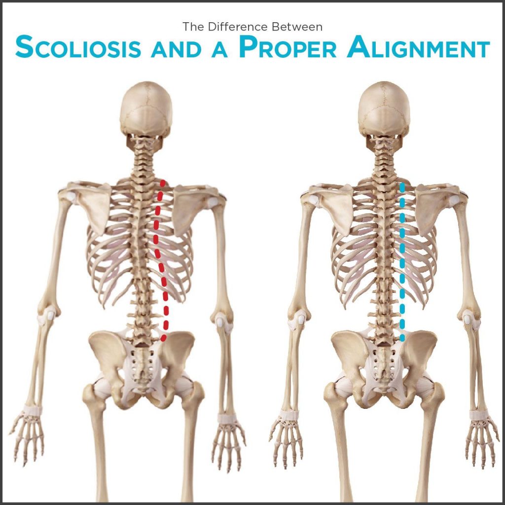Progression of Adult Scoliosis