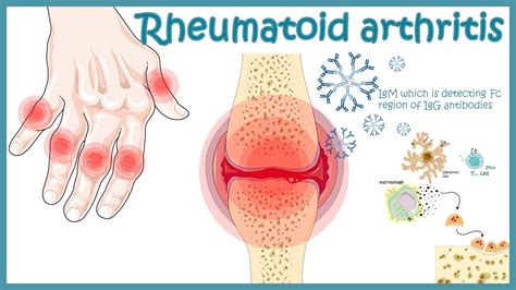Rheumatoid Arthritis