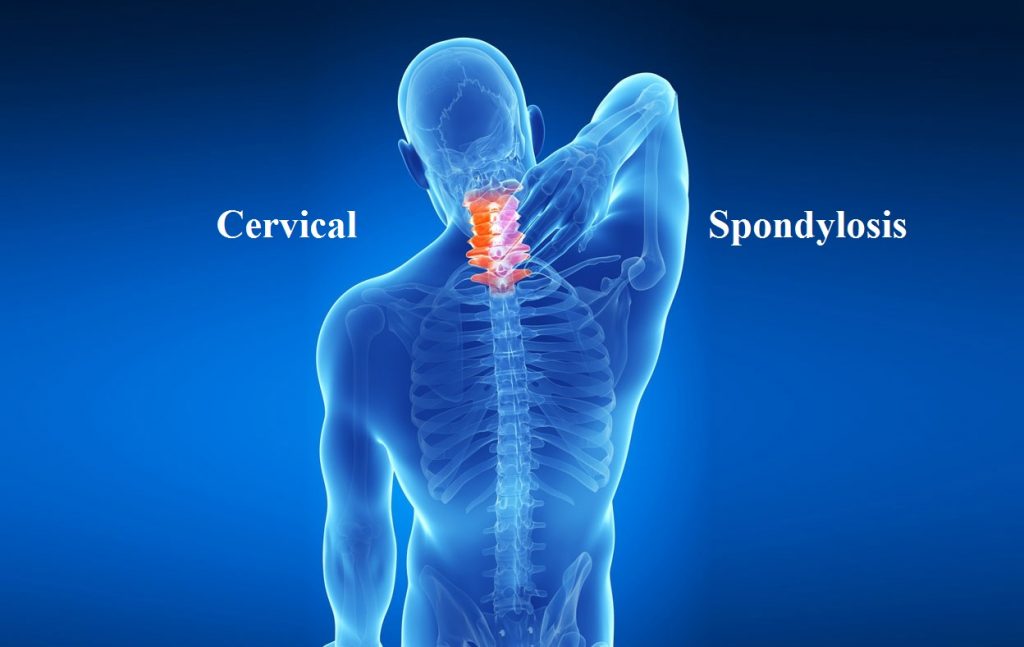 Cervical Spondylosis Illustration