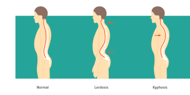 Illustration of Kyphosis and Lordosis