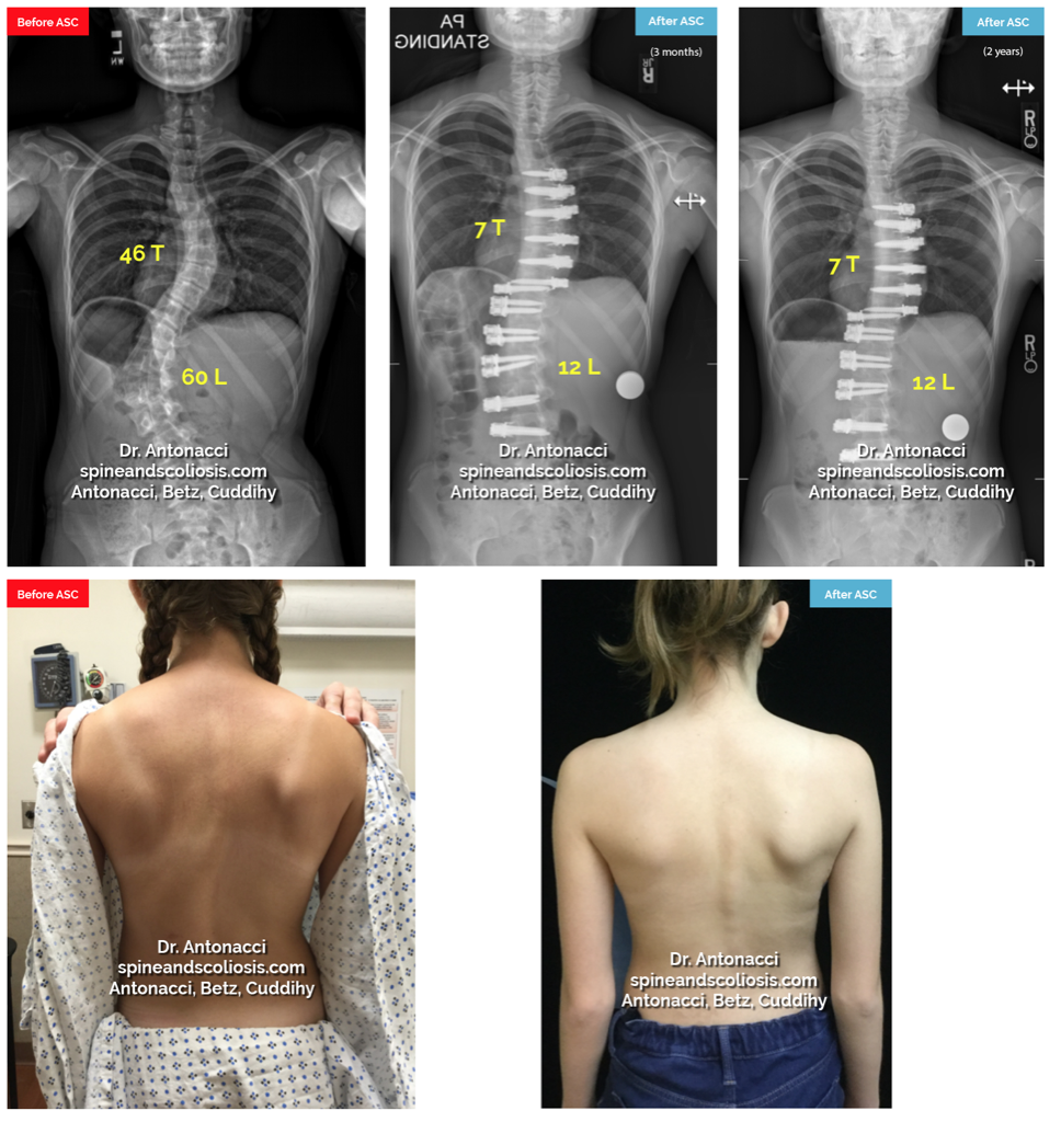 Scoliosis Before and After Surgery