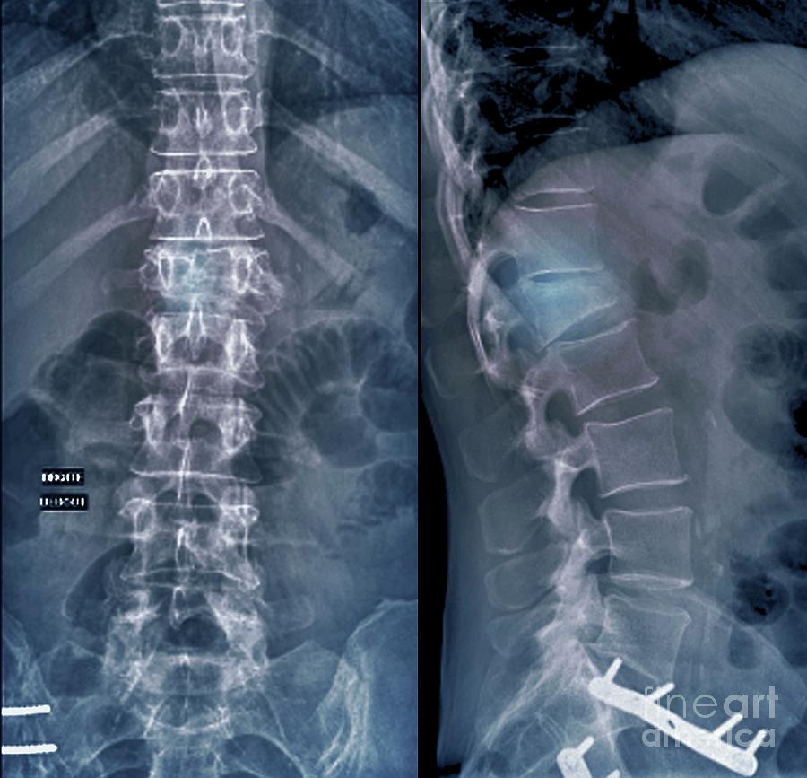 Understanding Spinal Fractures: Causes, Diagnosis, and Treatment?