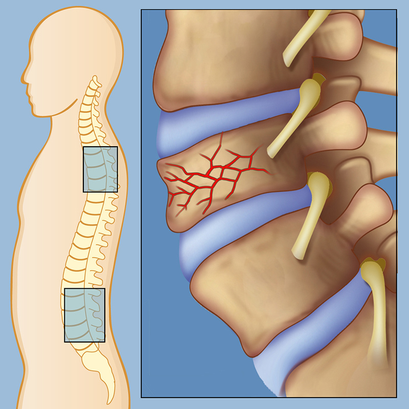 Understanding Spinal Fractures