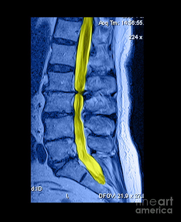 Severe Spinal Stenosis Medical Scan