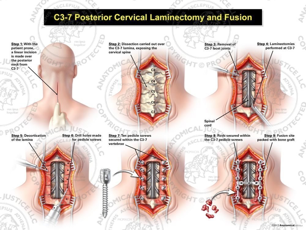 Posterior Cervical Laminectomy and Fusion