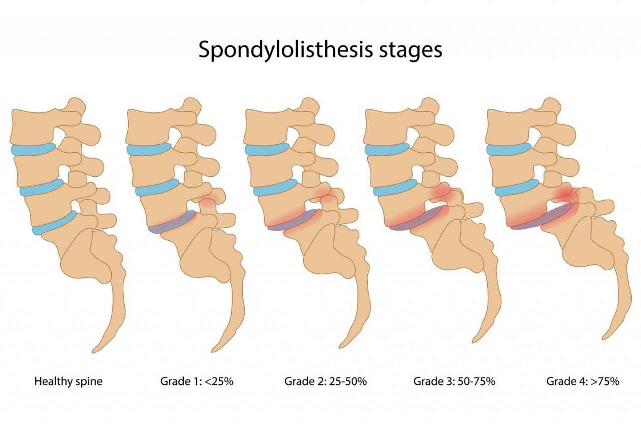 Understanding Spondylosis and Degenerative Spinal Conditions