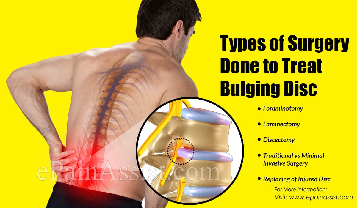 Types of Surgery to Treat Bulging Disc