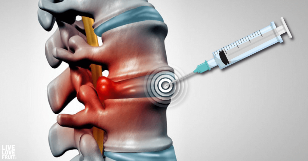 What Are Spinal Injections And How Can They Relieve Chronic Back Pain Becker Spine