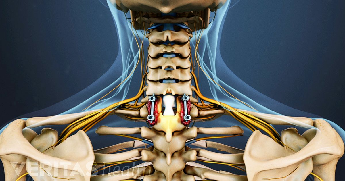 Cervical Laminectomy Fusion