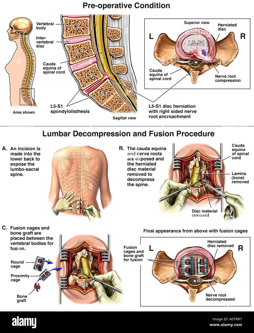Spine Surgery Illustration