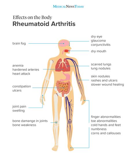 Rheumatoid Arthritis symptoms illustration