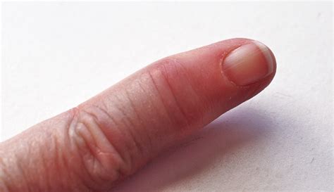 Arthritis in fingers