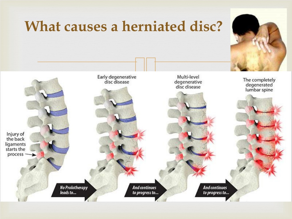 Illustration of a Herniated Disc