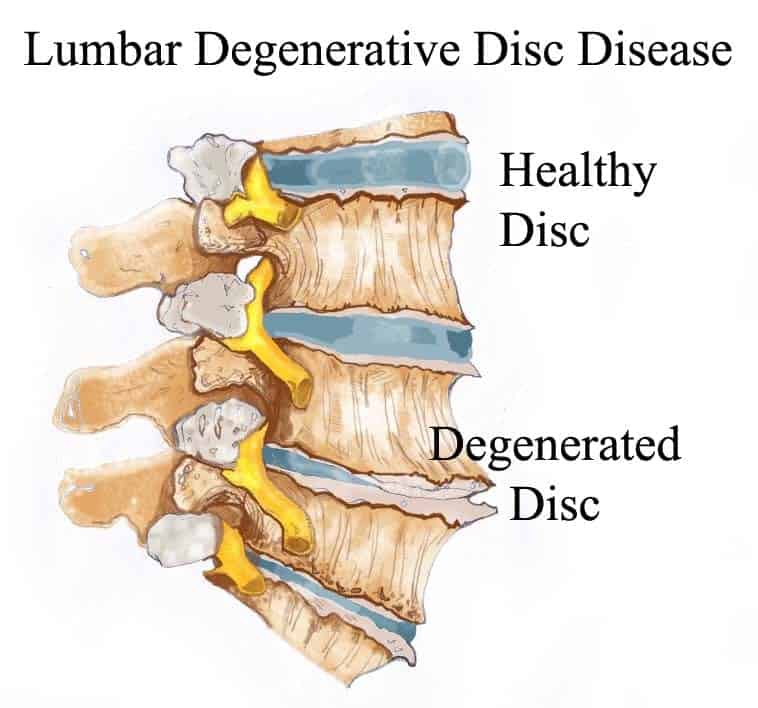 Cervical Degenerative Disc Disease