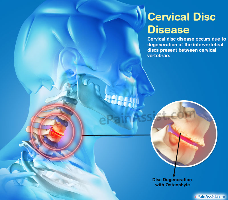 Cervical Disc Disease