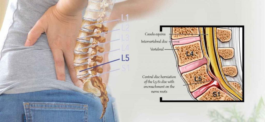 Illustration of a herniated L5-S1 disc