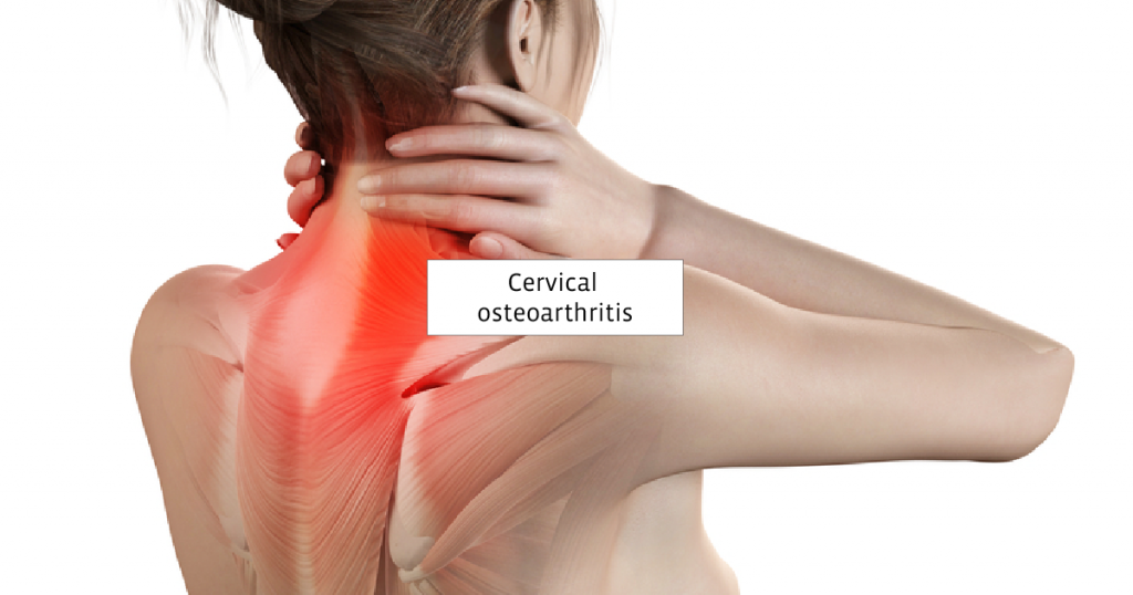 Cervical Osteoarthritis Illustration