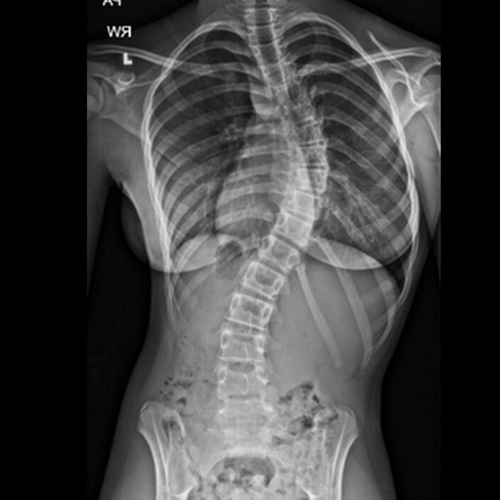 Progression of adult scoliosis over time