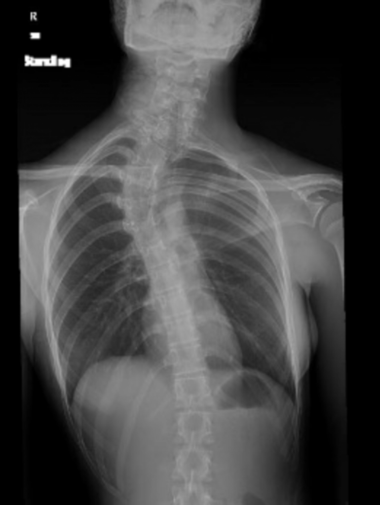 Scoliosis Types and Treatment