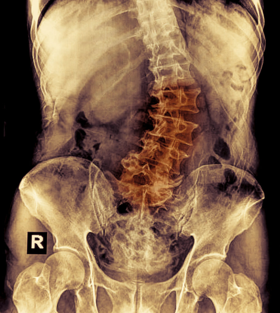 Back Pain due to Scoliosis