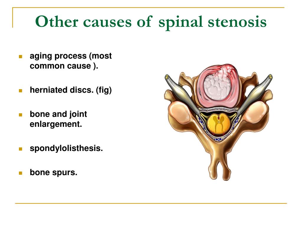 Factors leading to Spinal Stenosis