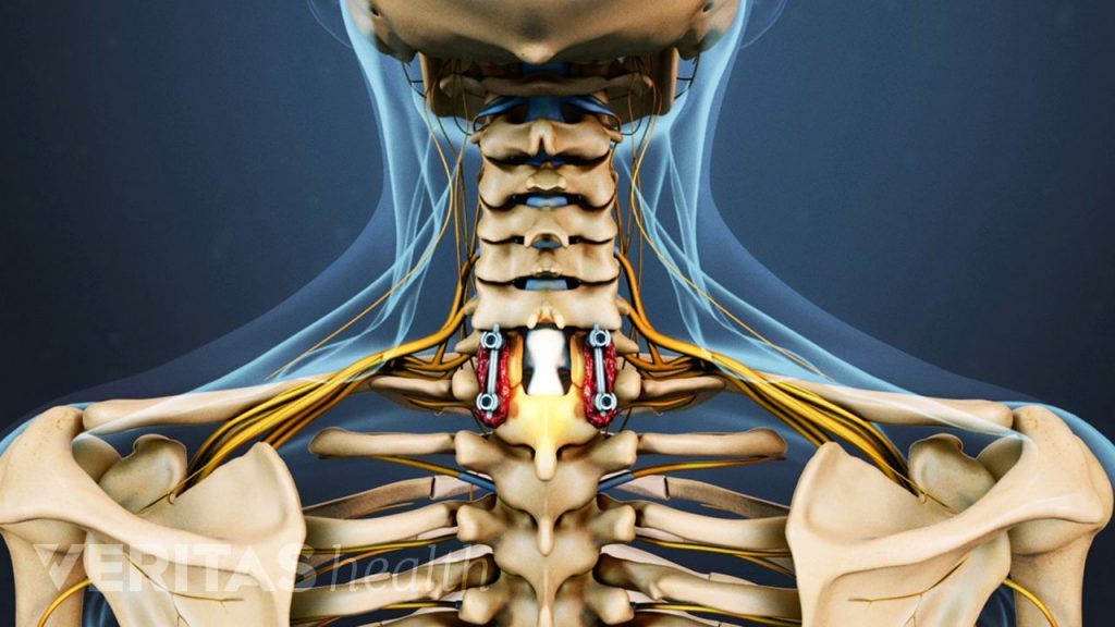 Cervical Laminectomy Procedure