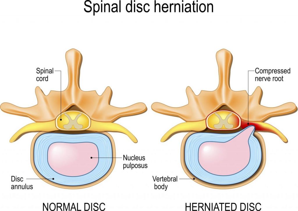 Lumbar Disc Herniation Image