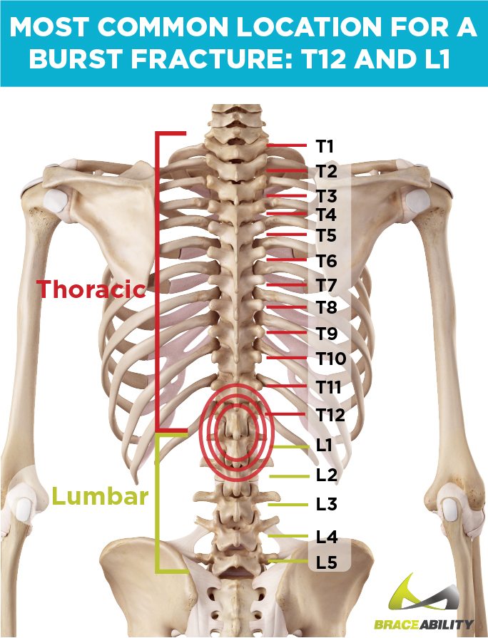 Location of common compression fracture on the spine