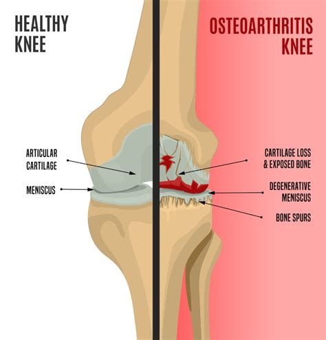 Arthritis affected joint