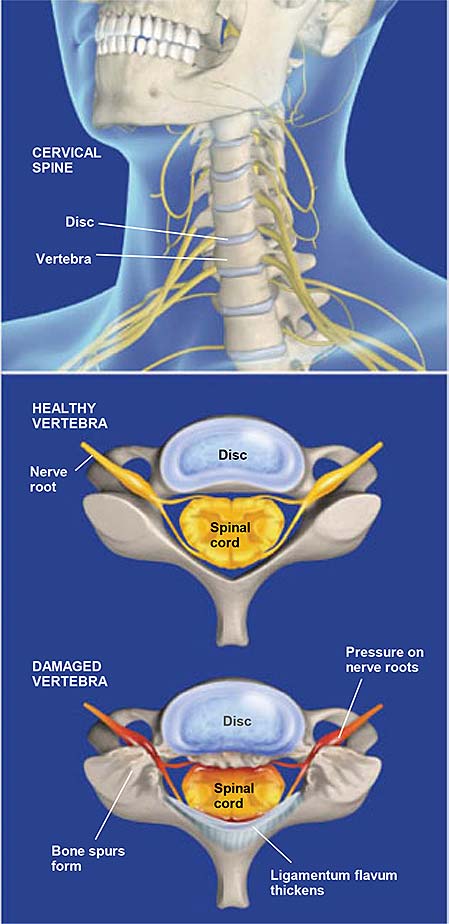Illustration of Cervical Spinal Stenosis