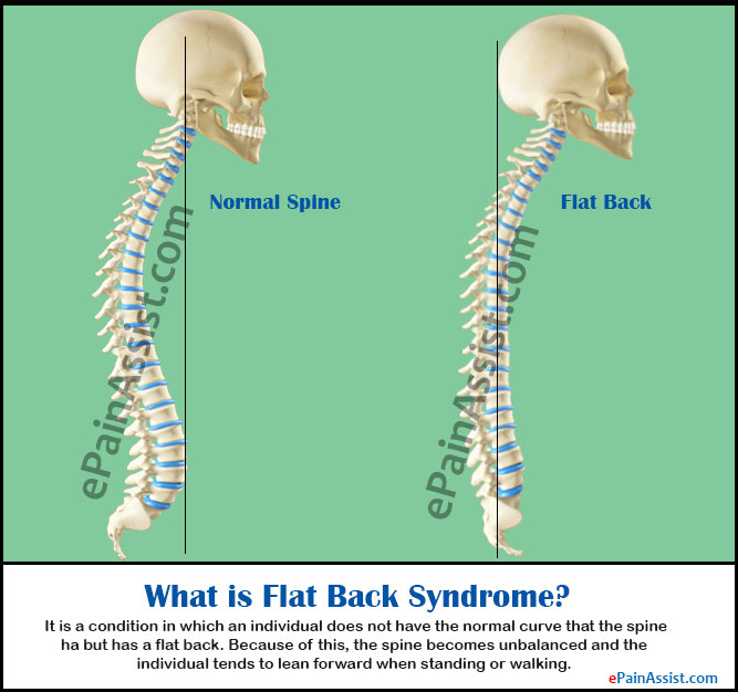Image depicting Flatback Syndrome