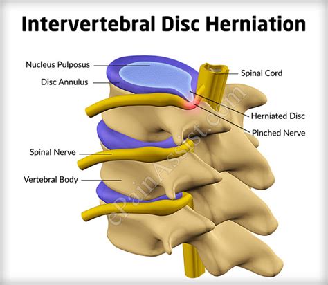 Intervertebral Disc Herniation