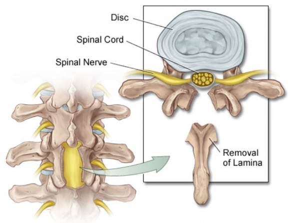 Lumbar Laminectomy Procedure