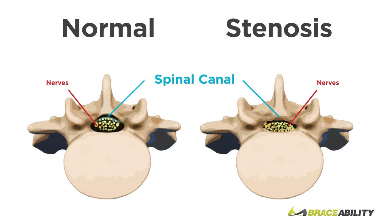 Comparison of Normal and Spinal Stenosis Vertebrae