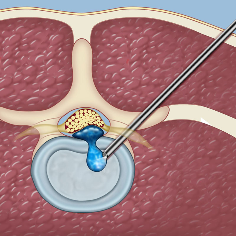 Spinal Endoscopy Procedure