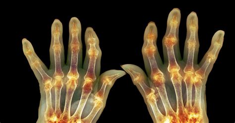 What is Rheumatoid Arthritis (RA) and How Does It Affect the Body?