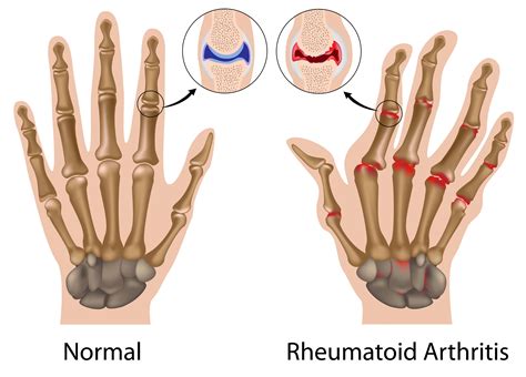 What is Rheumatoid Arthritis? Symptoms, Causes, and Treatments