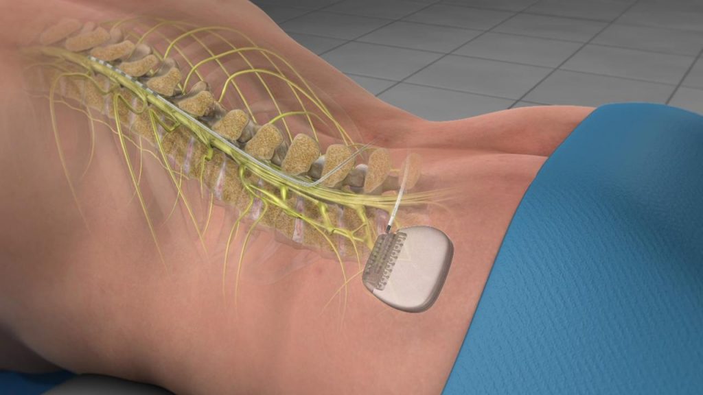 Spinal Cord Stimulation Device