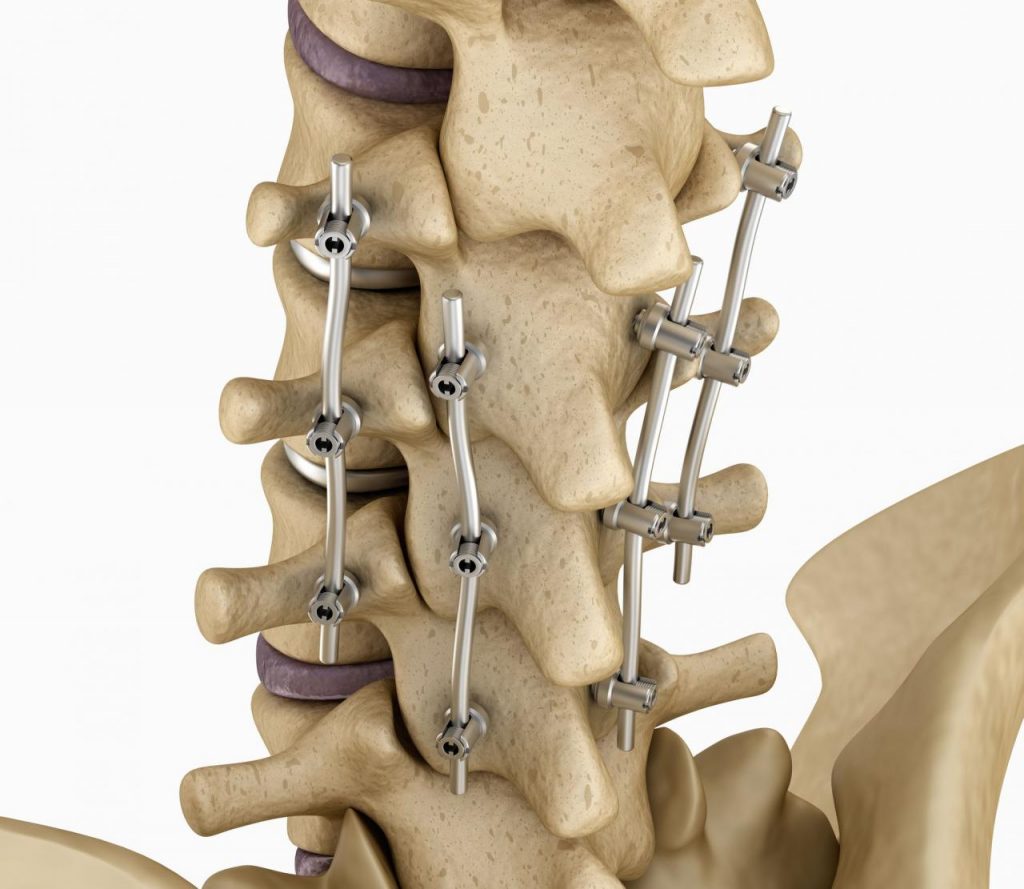 What is Spinal Fusion? Understanding its Purpose and Procedures