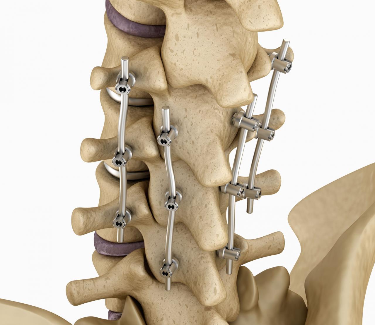What is Spinal Fusion? Understanding its Purpose and Procedures