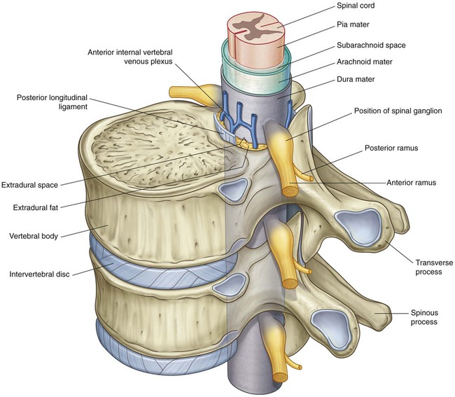 Illustration of Spinal Stenosis