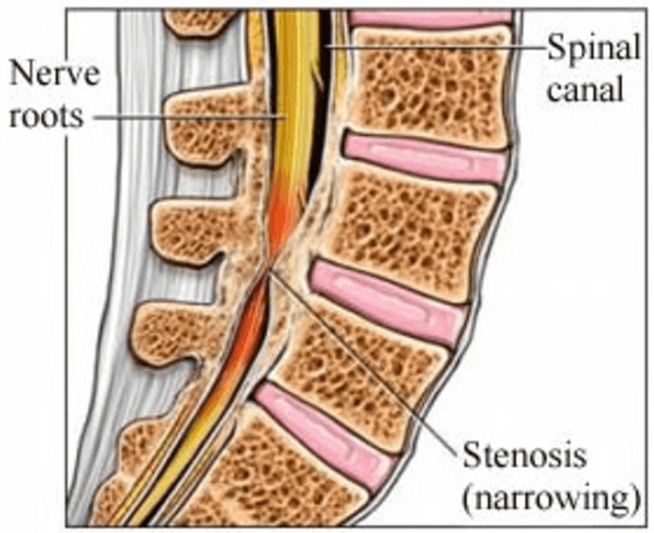 Understanding Spinal Stenosis