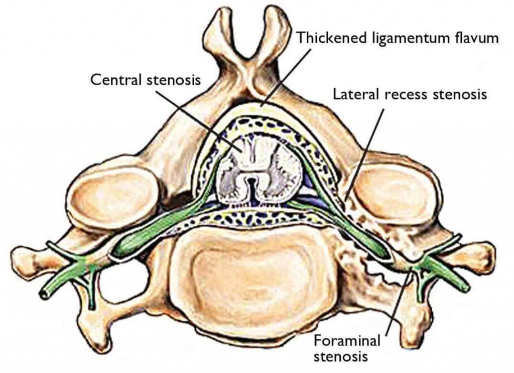 Spinal Stenosis Illustration
