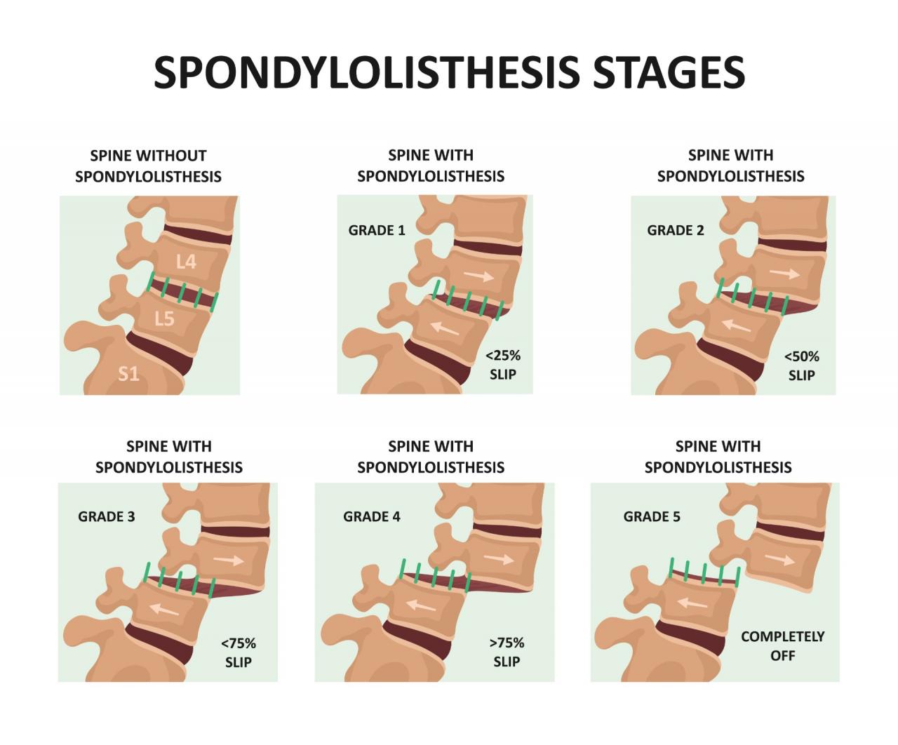 Spondylolisthesis Spinal Condition