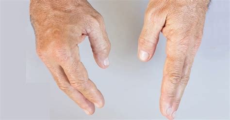 20 Effective Home Remedies for Rheumatoid Arthritis: A Comprehensive Guide